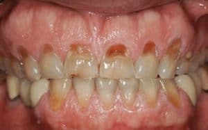 clenching teeth causes gum recession and cavities