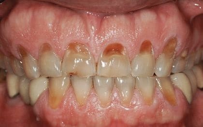 What are the Top 4 Causes of Teeth Wear?