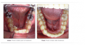 sleep apnea dentist treatment