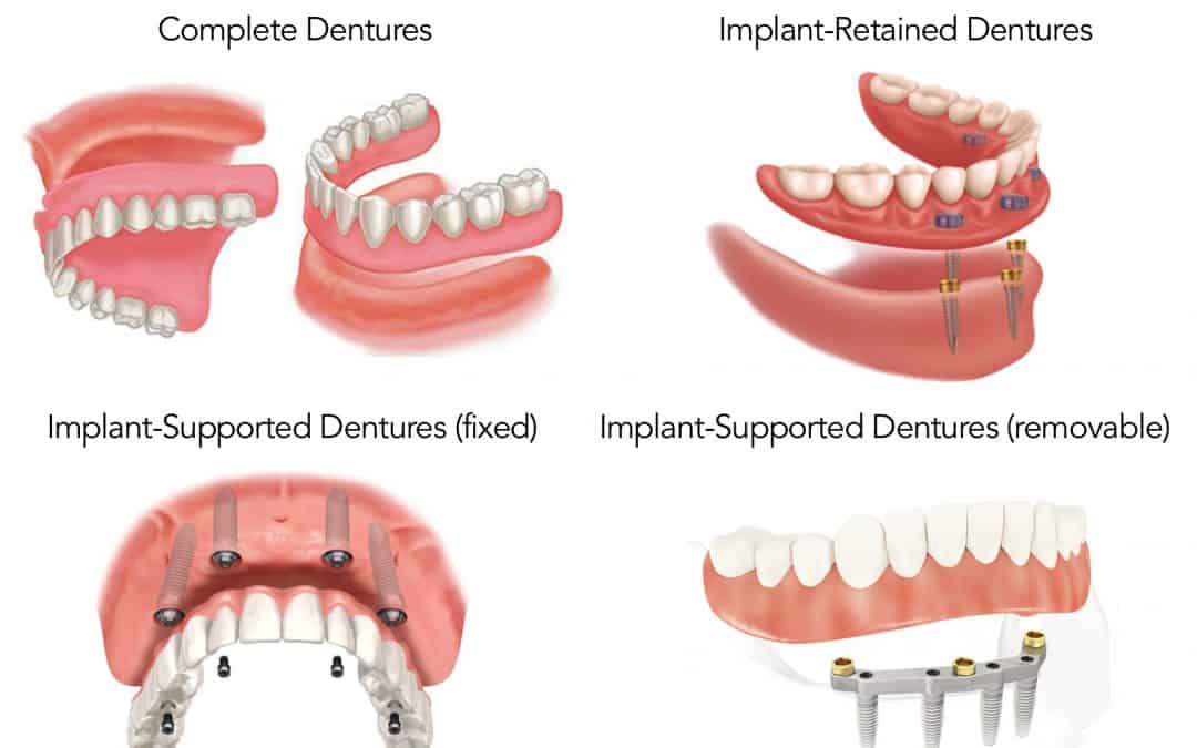 Snap on Dentures vs Full Mouth Permanent Implants