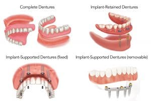 implant dentures vs all on 4