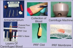 prf bone graft material