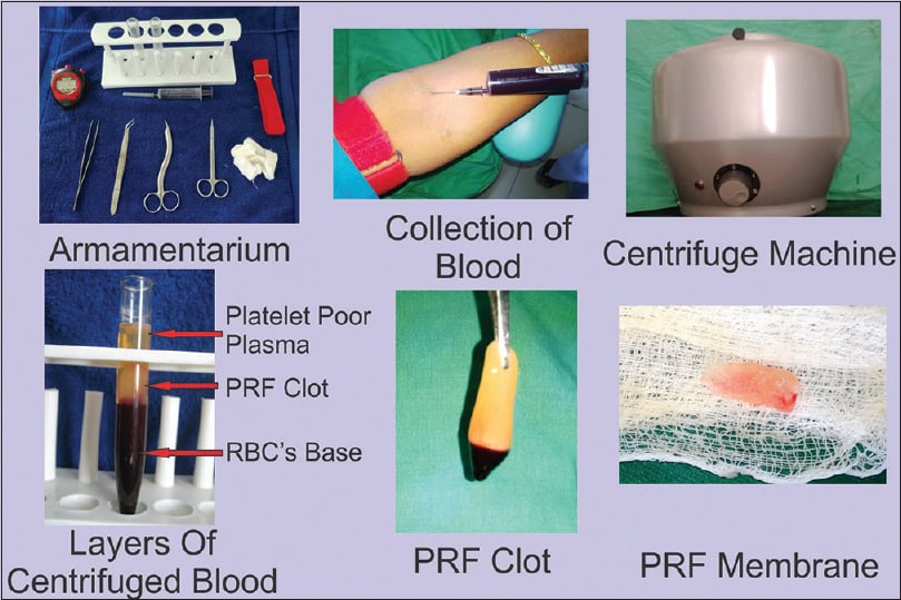 How is PRF Used in Dental Surgery