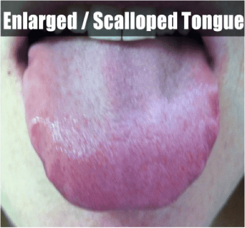 scalloped tongue