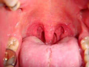 obstructive tongue position in apnea