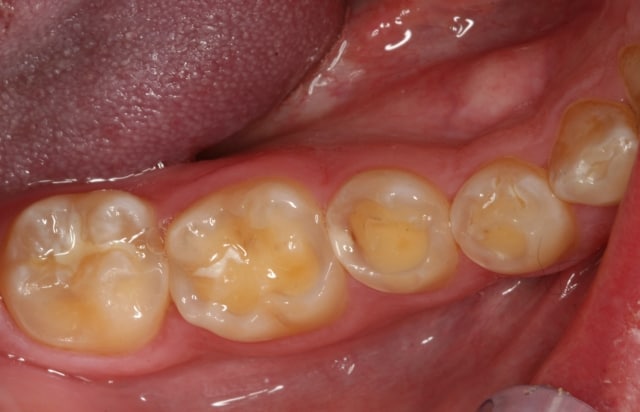 clenching tmj fillings crowns