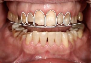 tooth wear treatment