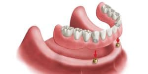 snap on denture procedure