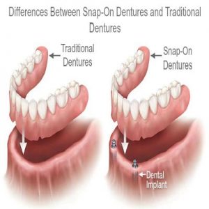 snap on dentures before and after