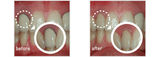 zirconia implants before and after