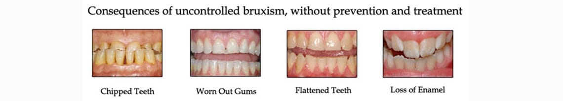 can dieting cause bruxism