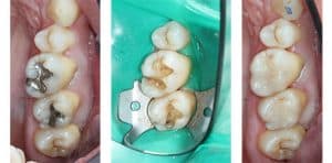 holistic removal of amalgam fillings