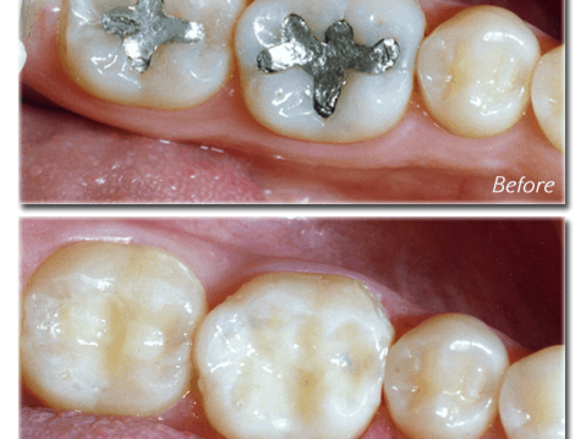 Composite vs Silver Dental Filling