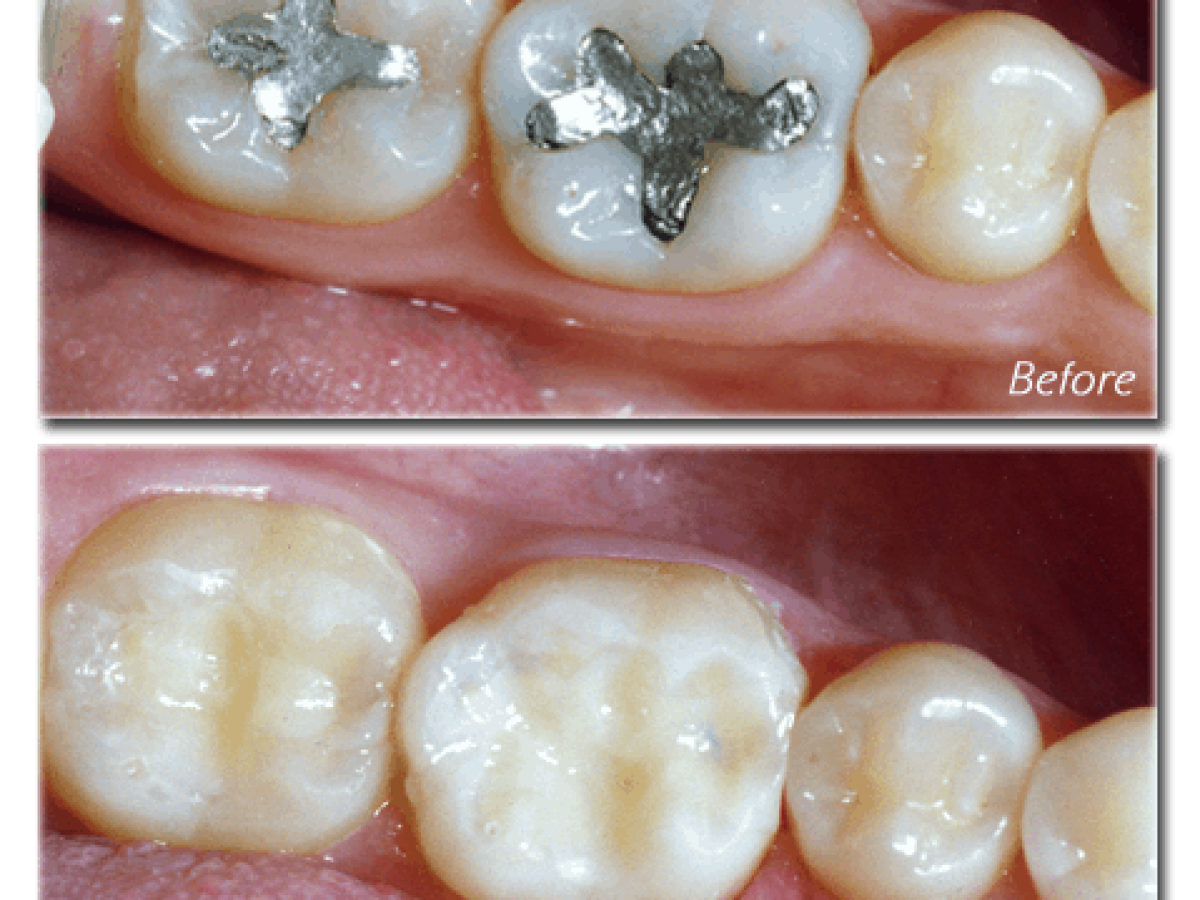 How Do Metal Colored Amalgam Fillings Compare To Composites