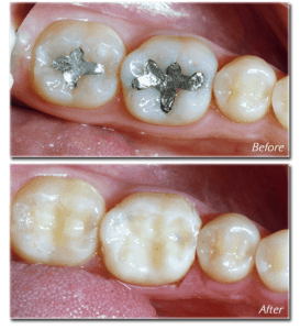 composite vs silver fillings