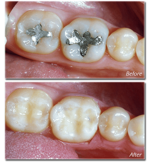 Silver fillings vs white hot sale fillings