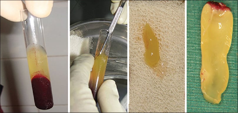 biological bone graft