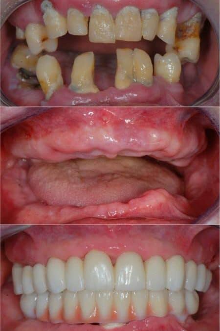 Full Mouth Zirconia Implant Teeth