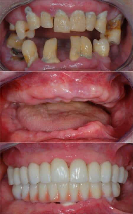 zirconia complete implants on titanium