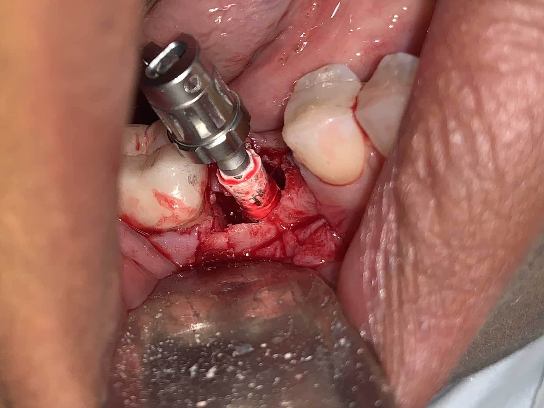zeramex P6 removal