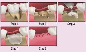 bone graft after abscess