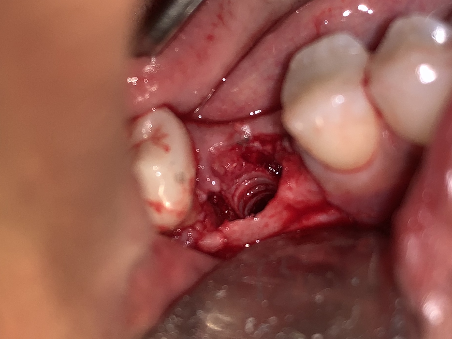 zeramex p6 implant extraction site