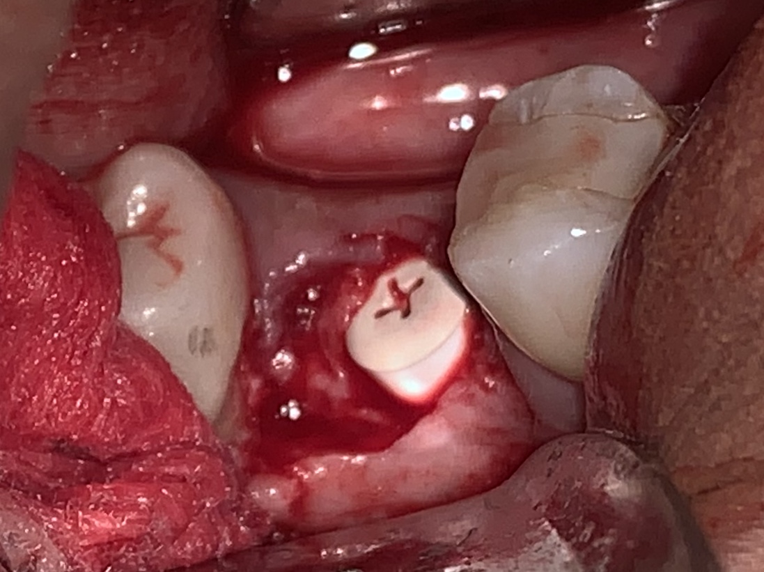 zeramex implant placement final