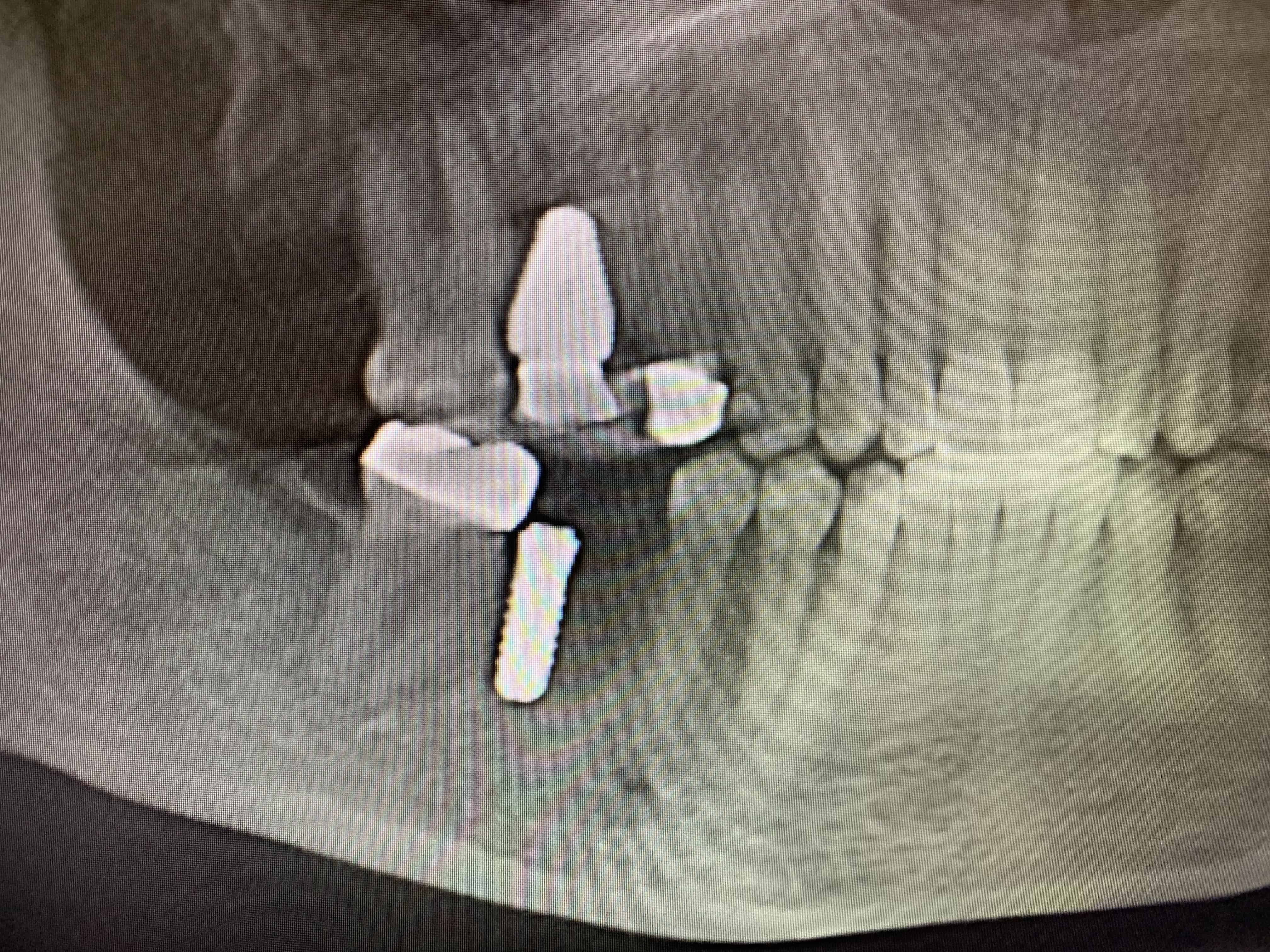 implant complications
