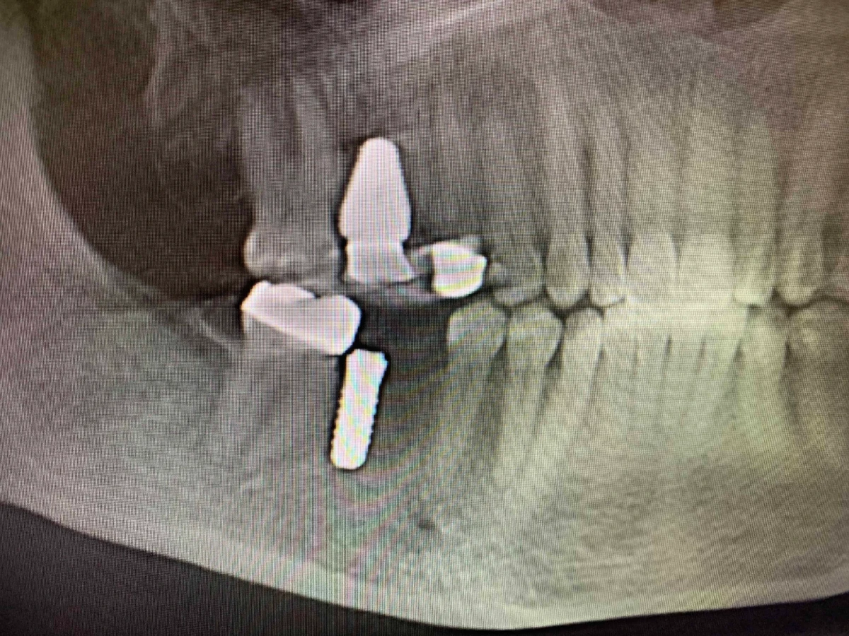 implant complications