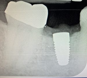 zeramex XT implant after picture