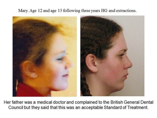 face profile change bicuspid extraction