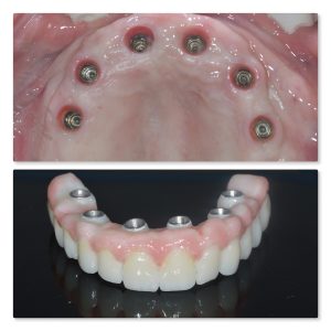 all on 4 full implants in one day