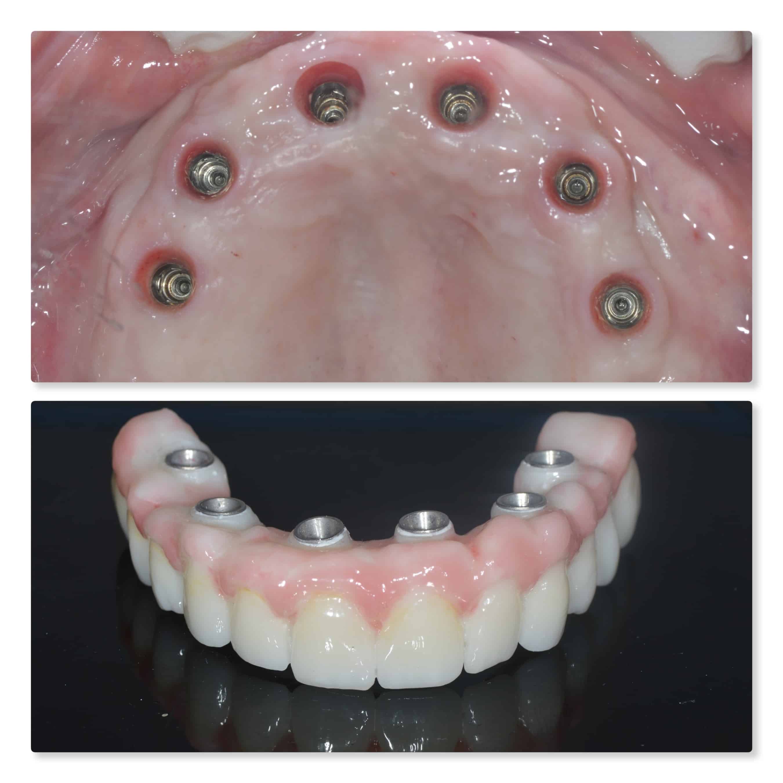 all on 4 full implants in one day