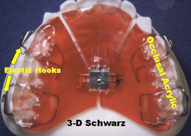 Palatal Expanders can Fix Pediatric Sleep Apnea