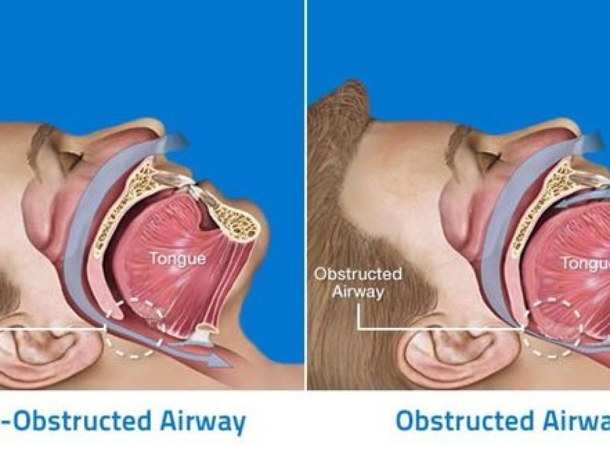 How to Stop Mouth Breathing