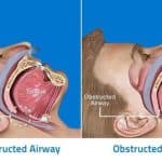 How to Stop Mouth Breathing