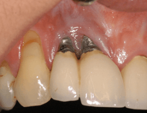 tooth implant problems