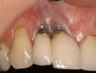 Dental Implant Complications and Problems