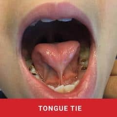 ALF and tongue tie treatment