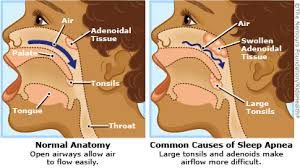 Can Sleep Apnea Be Cured?