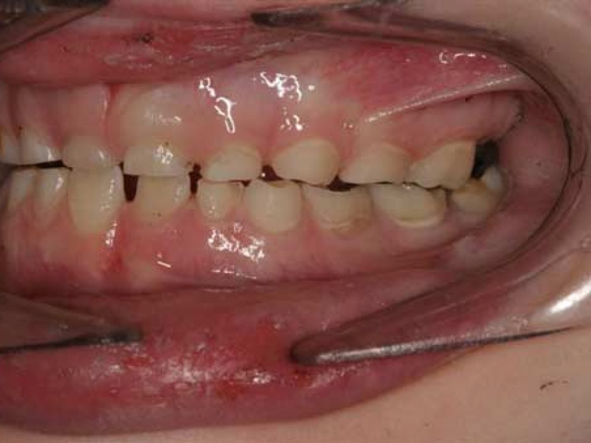 Kids Teeth Grinding Apnea 1200x900 