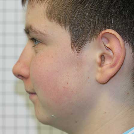 reverse chin profile