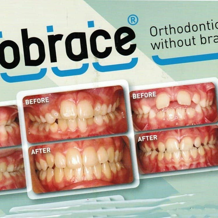 Can Myobrace Expanders be an Alternative to Braces?