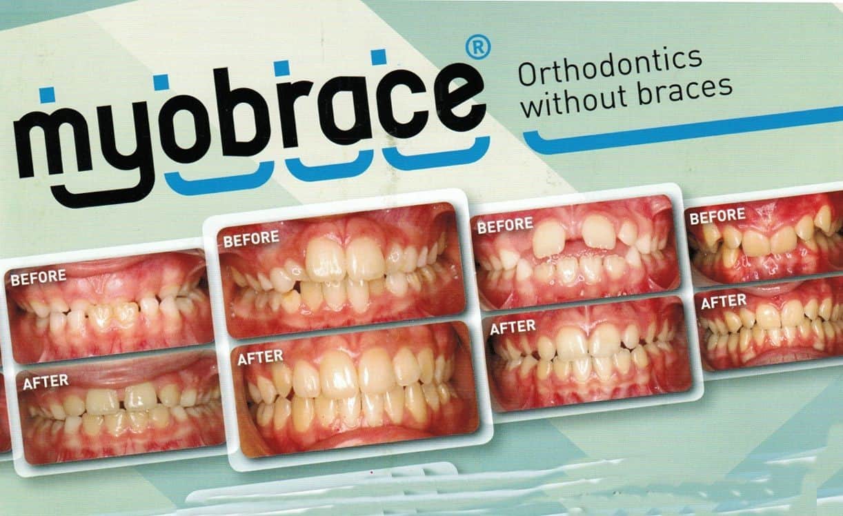 Can Myobrace Expanders be an Alternative to Braces?