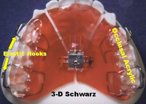 schwarz palatal expander 