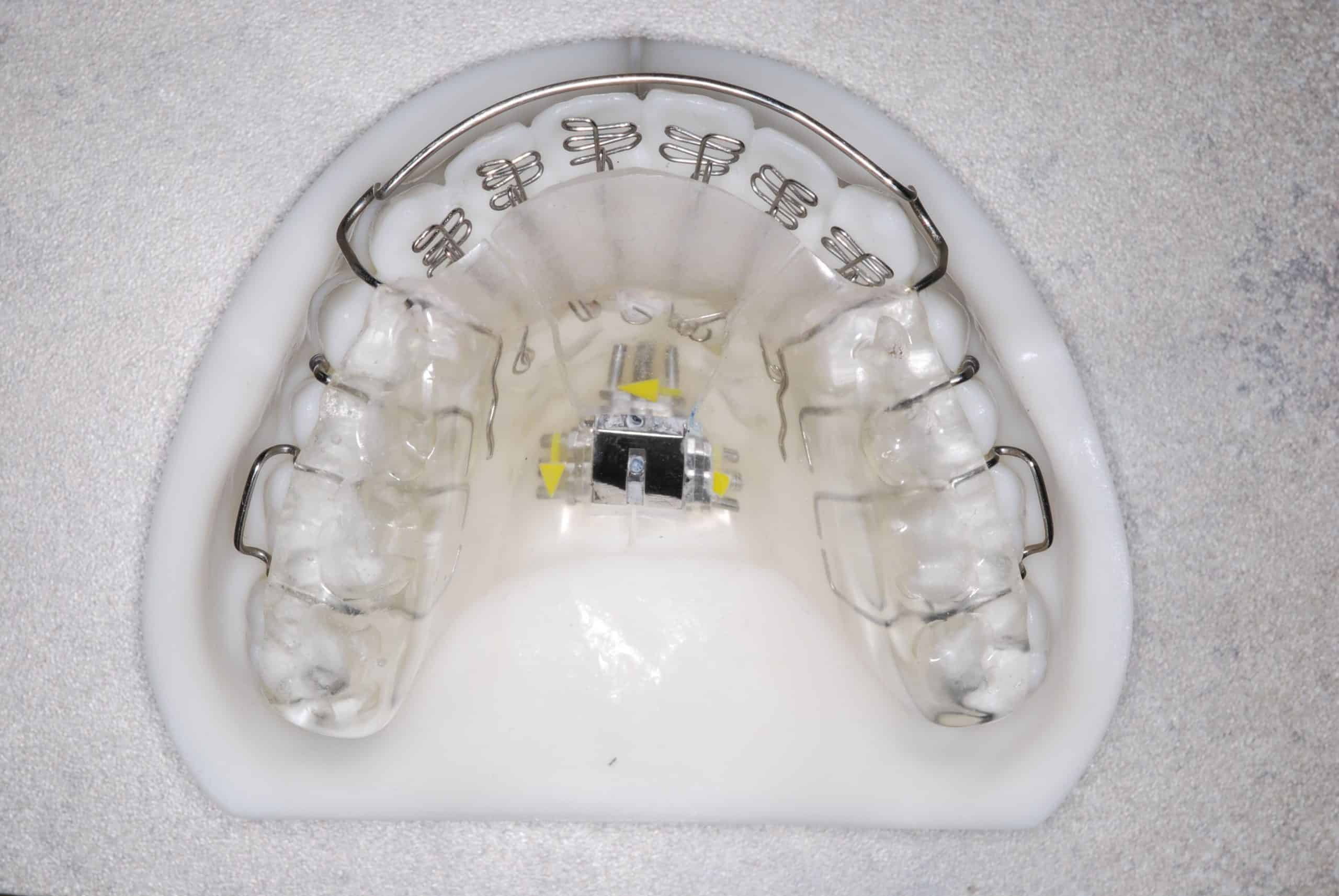 Adult Palatal Expanders Fix Mouth Breathing And TMJ, 57% OFF