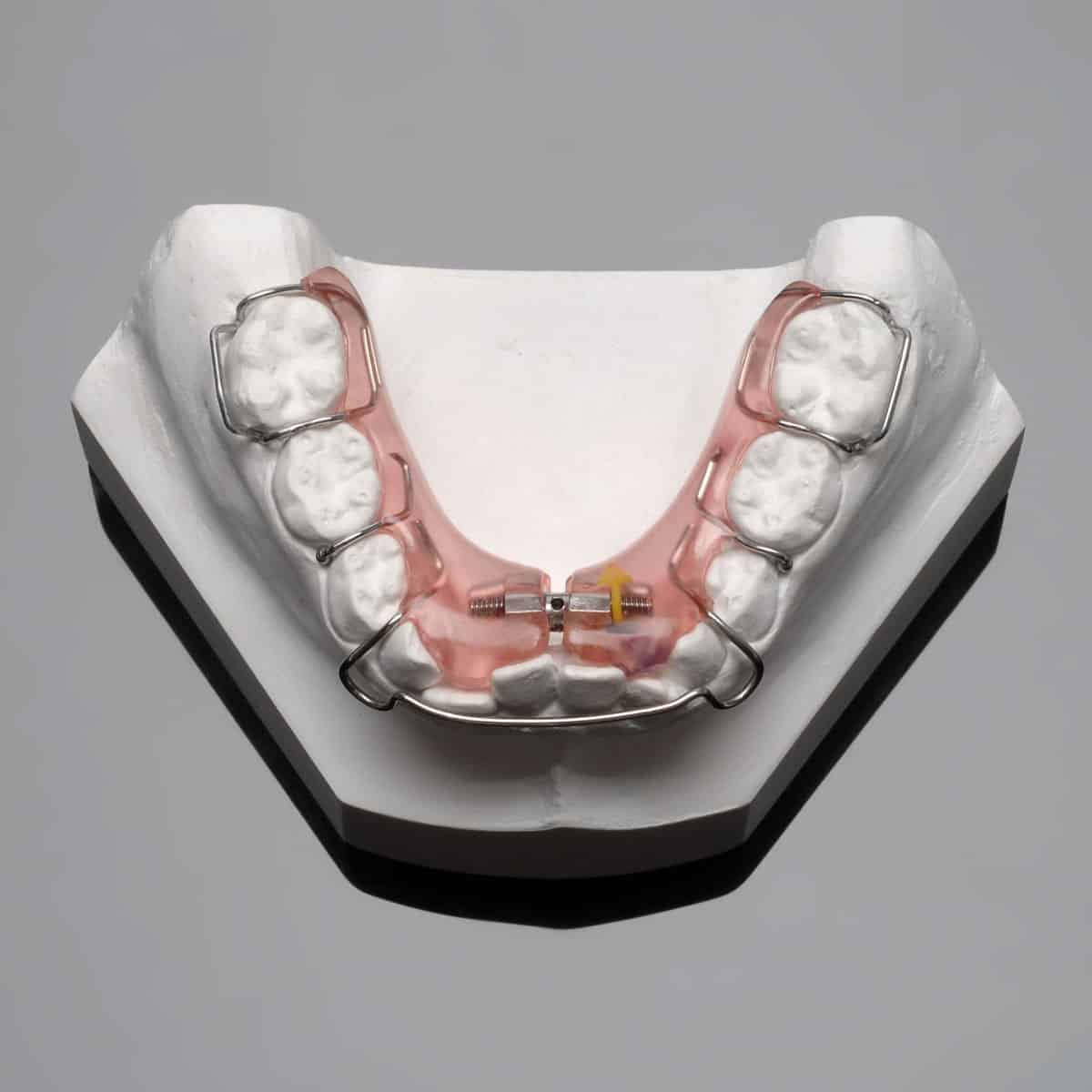 Orthodontic Appliances Arch at Frank Kahler blog