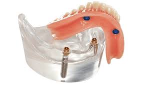 snap in dentures vs implants