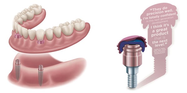 snap-on denture attachment system