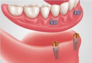 cost of snap in dentures